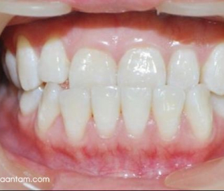 KHỚP CẮN NGƯỢC LÀ NHƯ THẾ NÀO?CÁCH KHẮC PHỤC NHƯ THẾ NÀO?