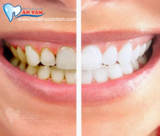 TÁC HẠI CỦA VÔI RĂNG