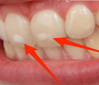 NHA KHOA BẢO TỒN - RĂNG NHIỄM FLUOR: NGUYÊN NHÂN TRIỆU CHỨNG VÀ CÁCH PHÒNG NGỪA