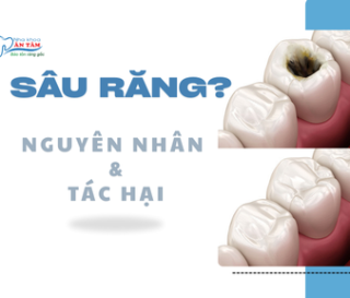 NHA KHOA BẢO TỒN - NGUYÊN NHÂN VÀ TÁC HẠI CỦA SÂU RĂNG?