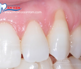 NGUYÊN NHÂN GÂY TỤT LỢI VÀ CÁCH ĐIỀU TRỊ HIỆU QUẢ