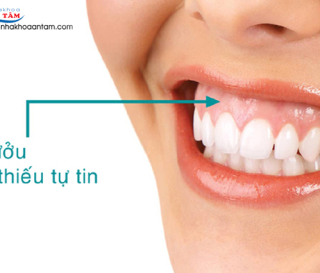 CƯỜI HỞ LỢI LÀ GÌ? ĐIỀU TRỊ HỞ LỢI NHƯ THẾ NÀO?