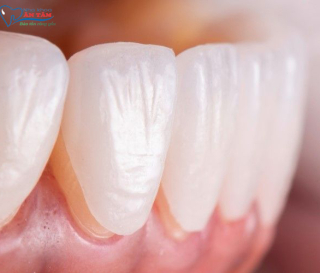 NHA KHOA BẢO TỒN - ƯU VÀ NHƯỢC ĐIỂM CỦA DÁN RĂNG SỨ VENEER
