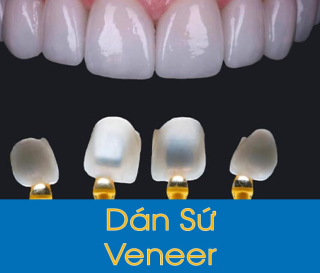 ĐỘ BỀN CỦA MẶT DÁN SỨ ĐƯỢC BAO LÂU?