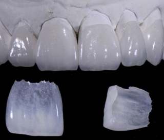 NHA KHOA BẢO TỒN - DÁN RĂNG SỨ VENEER MẤT BAO LÂU?