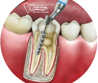 NHA KHOA BẢO TỒN - CHỮA TỦY RĂNG SỐ 7 CÓ PHỨC TẠP KHÔNG?