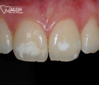 NHA KHOA BẢO TỒN - VÌ SAO RĂNG CÓ ĐỐM TRẮNG? CÁCH KHẮC PHỤC HIỆU QUẢ