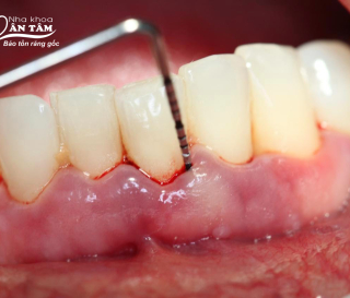 NHA KHOA BẢO TỒN - VIÊM NHA CHU CÓ NGUY HIỂM KHÔNG?