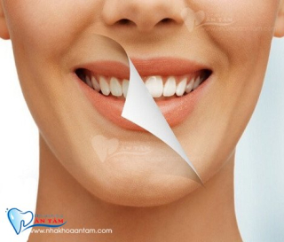 CHĂM SÓC RĂNG SAU KHI TẨY TRẮNG
