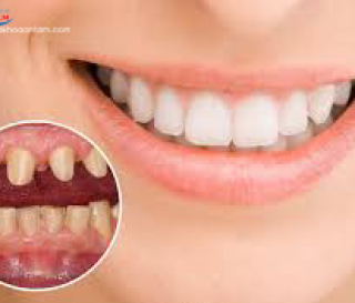ĐỘ TUỔI NÀO PHÙ HỢP ĐỂ BỌC RĂNG SỨ