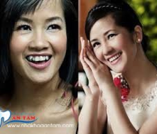 CÓ NÊN NHỔ RĂNG KHỂNH KHÔNG?
