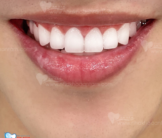 BỌC RĂNG SỨ Ở ĐÂU TỐT NHẤT