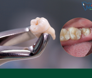 NHA KHOA BẢO TỒN - CÓ NÊN NHỔ RĂNG KHÔN KHÔNG?