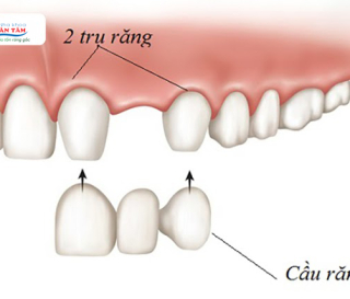 CÓ NÊN LÀM CẦU RĂNG SỨ CHO RĂNG CỬA KHÔNG?