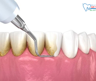LỢI ÍCH CỦA VIỆC LẤY CAO RĂNG