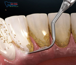 NHA KHOA BẢO TỒN - CÓ NÊN LẤY VÔI RĂNG THƯỜNG XUYÊN KHÔNG?