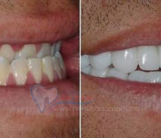 RĂNG BỊ MÓM CÓ BỌC SỨ ĐƯỢC KHÔNG?