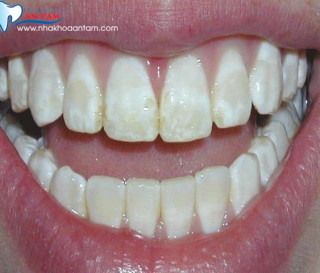RĂNG NHIỄM FLUOR LÀ GÌ?CÁCH ĐIỀU TRỊ NHƯ THẾ NÀO?