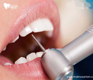 MÀI KẼ RĂNG CÓ ẢNH HƯỞNG GÌ KHÔNG?