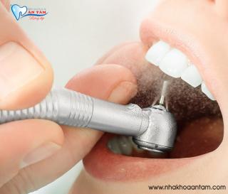 BỌC RĂNG SỨ KHÔNG MÀI RĂNG ĐƯỢC KHÔNG?