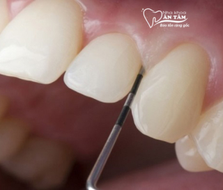 NHA KHOA BẢO TỒN - KHI NÀO CẦN MÀI RĂNG NGẮN LẠI?