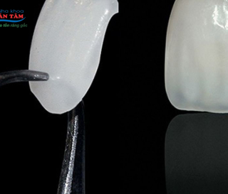 NHA KHOA BẢO TỒN - TUỔI THỌ CỦA MẶT DÁN SỨ VENEER LÀ BAO LÂU?
