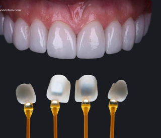 DÁN SỨ VENEER CÓ GÂY HÔI MIỆNG KHÔNG?