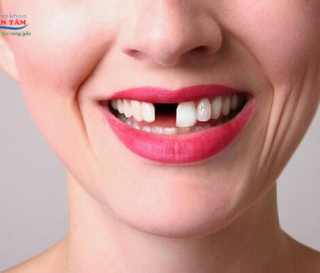 MẤT RĂNG BAO LÂU THÌ BỊ TIÊU XƯƠNG HÀM.