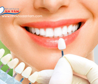 04 MÀU VENEER PHỔ BIẾN & CHỌN MÀU RĂNG CHO VENEER SỨ