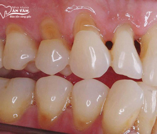 NHA KHOA BẢO TỒN - MÒN CỔ CHÂN RĂNG: NGUYÊN NHÂN VÀ CÁCH PHÒNG NGỪA