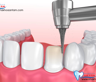 NHA KHOA BẢO TỒN - KỸ THUẬT MÀI RĂNG THẾ NÀO ĐÚNG CHUẨN?