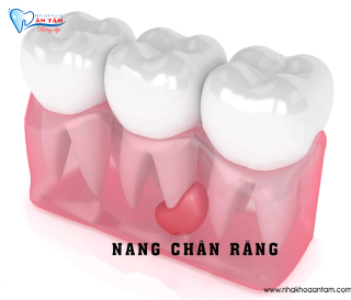 NANG CHÂN RĂNG LÀ GÌ? CÓ NGUY HIỂM KHÔNG?