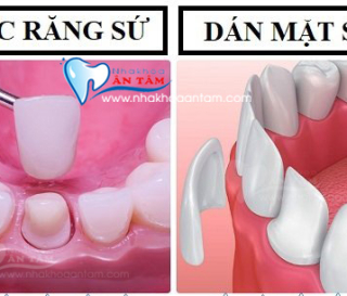 SỰ KHÁC BIỆT GIỮA DÁN SỨ VENEER VÀ BỌC RĂNG SỨ