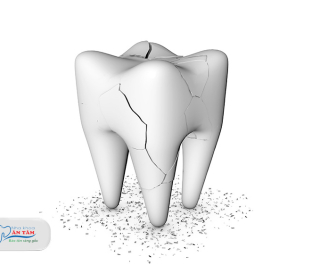 NHA KHOA BẢO TỒN - BỊ MẺ RĂNG HÀM CÓ SAO KHÔNG?