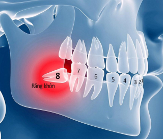 NHA KHOA BẢO TỒN - RĂNG KHÔN LÀ GÌ ???