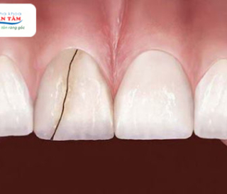 NHA KHOA BẢO TỒN - RĂNG BỊ NỨT CÓ TỰ LÀNH ĐƯỢC KHÔNG?