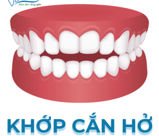 NHA KHOA BẢO TỒN - KHỚP CẮN HỞ LÀ GÌ? CÁCH ĐIỀU TRỊ KHỚP CẮN HỞ