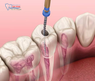 CÁC TRIỆU CHỨNG SAU KHI LẤY TỦY RĂNG