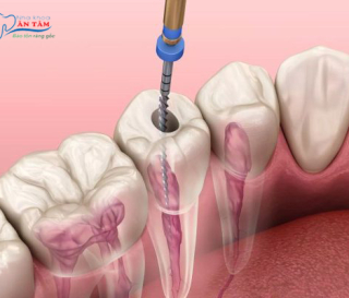 NHA KHOA BẢO TỒN - TUỔI THỌ RĂNG LẤY TỦY KÉO DÀI BAO LÂU?