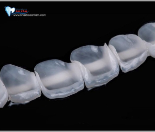 NHỮNG TRƯỜNG HỢP NÊN DÁN VENEER