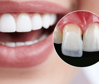 DÁN RĂNG SỨ KHÔNG MÀI RĂNG CÓ TỐT KHÔNG?