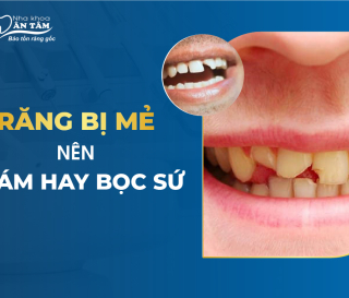 RĂNG MẺ NÊN TRÁM HAY BỌC SỨ?