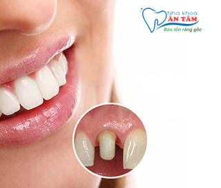 NHA KHOA BẢO TỒN - RĂNG BỌC SỨ BỊ VIÊM TỦY PHẢI LÀM SAO?