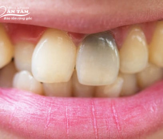 NHA KHOA BẢO TỒN - DẤU HIỆU RĂNG BỊ CHẾT TỦY VÀ CÁCH ĐIỀU TRỊ HIỆU QUẢ