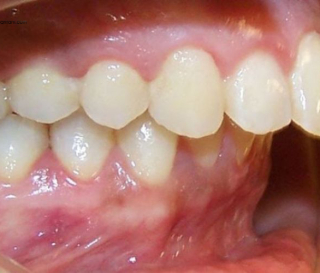 RĂNG VẨU LÀ GÌ? NGUYÊN NHÂN CÁCH KHẮC PHỤC HIỆU QUẢ