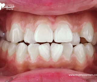 LÀM GÌ VỚI RĂNG KHẤP KHỂNH