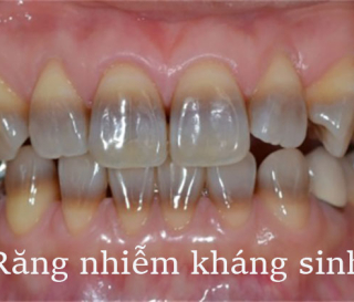 NHA KHOA BẢO TỒN - NGUYÊN NHÂN VÀ CÁCH KHẮC PHỤC RĂNG NHIỄM KHÁNG SINH