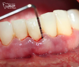 PHẢI LÀM GÌ KHI RĂNG SÂU CHẢY MÁU?