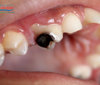 NHA KHOA BẢO TỒN - ĐAU RĂNG SÂU NÊN LÀM GÌ?