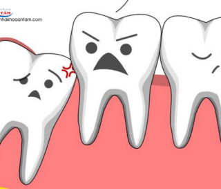 NHẬN DIỆN CÁC KIỂU RĂNG KHÔN MỌC PHỔ BIẾN